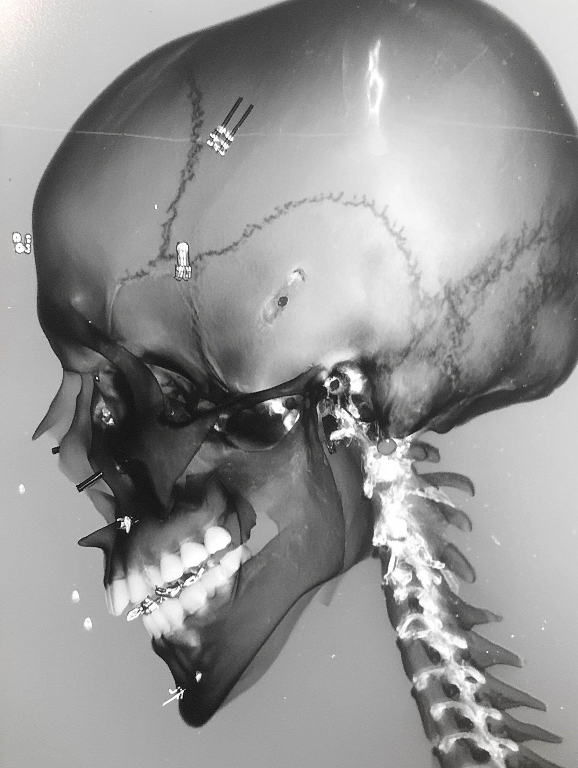 Ultra Close-Up 3D X-Ray of Skull and Bone
